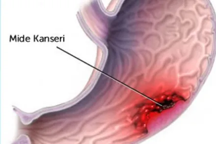 Mide kanseri çizimi